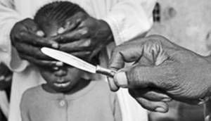 mutilazioni genitali